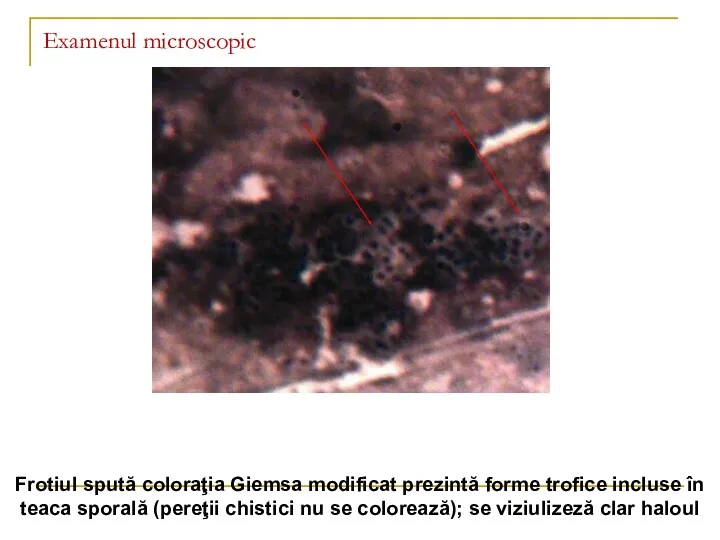 Examenul microscopic Frotiul spută coloraţia Giemsa modificat prezintă forme trofice incluse în teaca