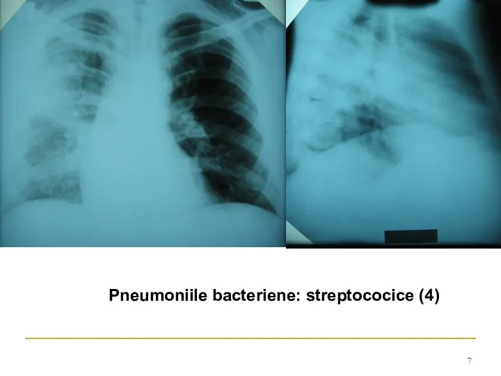 Pneumoniile bacteriene: streptococice (4)