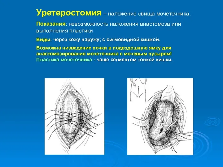 Уретеростомия – наложение свища мочеточника. Показания: невозможность наложения анастомоза или