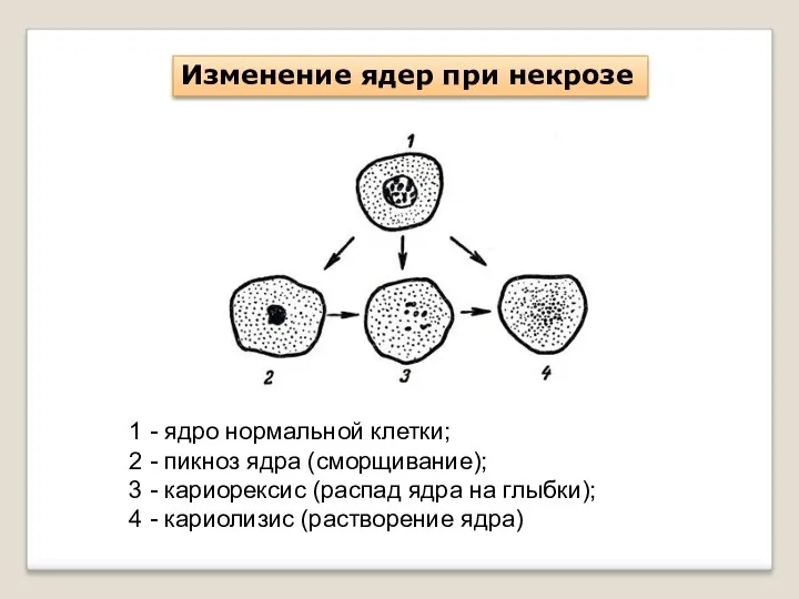 Изменение ядер при некрозе 1 - ядро нормальной клетки; 2