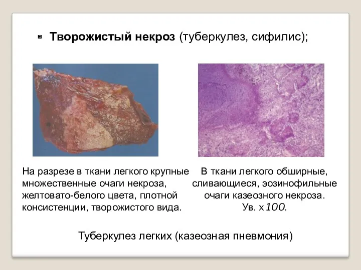 Творожистый некроз (туберкулез, сифилис); Туберкулез легких (казеозная пневмония) На разрезе