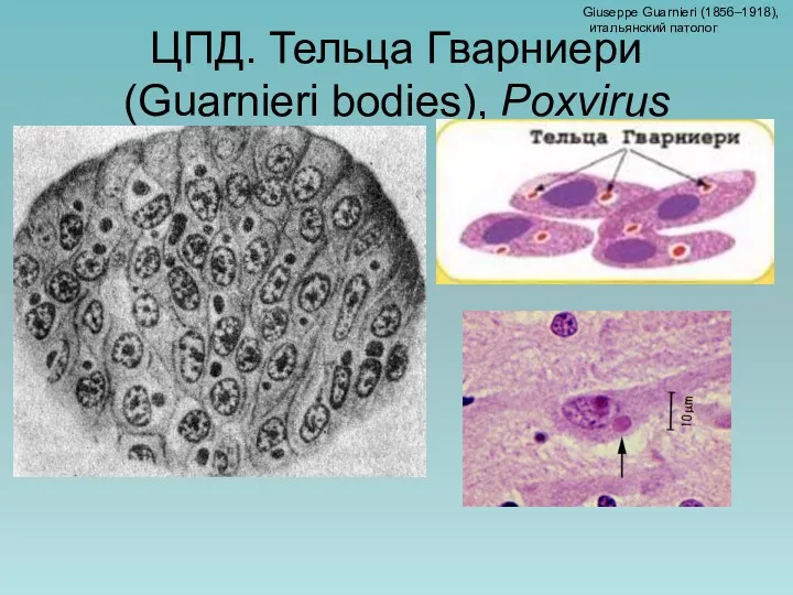 ЦПД. Тельца Гварниери (Guarnieri bodies), Poxvirus Giuseppe Guarnieri (1856–1918), итальянский патолог