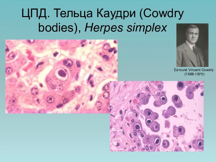 ЦПД. Тельца Каудри (Cowdry bodies), Herpes simplex Edmund Vincent Cowdry (1888-1975)