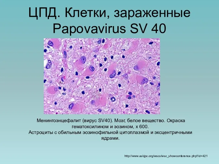 ЦПД. Клетки, зараженные Papovavirus SV 40 Менингоэнцефалит (вирус SV40). Мозг,