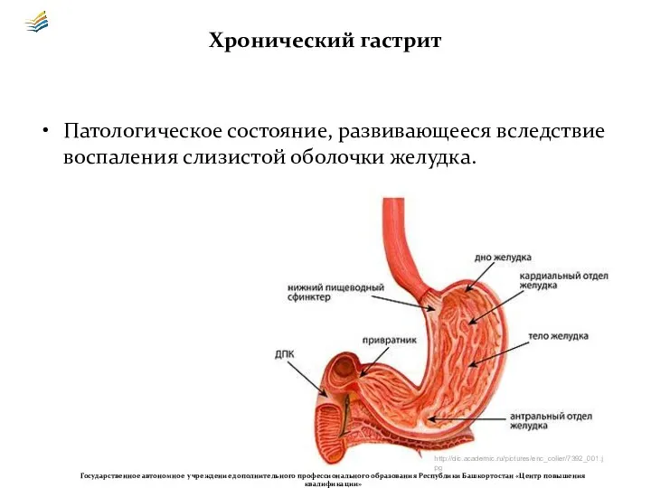 Хронический гастрит Патологическое состояние, развивающееся вследствие воспаления слизистой оболочки желудка.