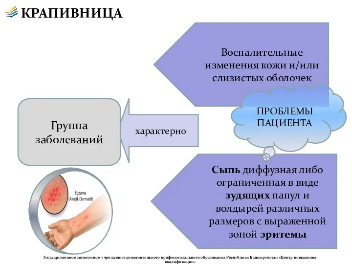 КРАПИВНИЦА характерно Воспалительные изменения кожи и/или слизистых оболочек Сыпь диффузная