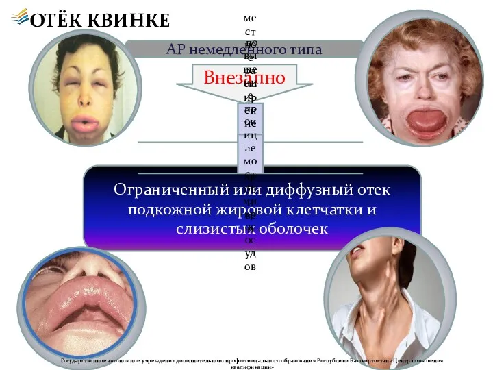 АР немедленного типа ОТЁК КВИНКЕ Ограниченный или диффузный отек подкожной