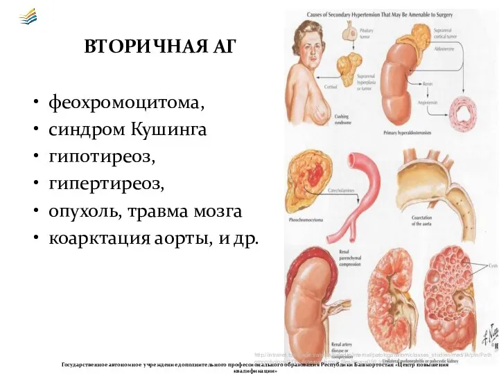 ВТОРИЧНАЯ АГ феохромоцитома, синдром Кушинга гипотиреоз, гипертиреоз, опухоль, травма мозга