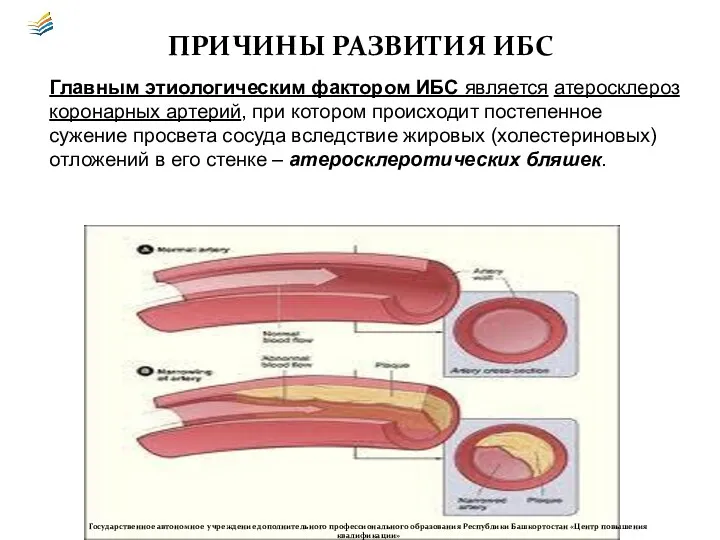 ПРИЧИНЫ РАЗВИТИЯ ИБС Главным этиологическим фактором ИБС является атеросклероз коронарных