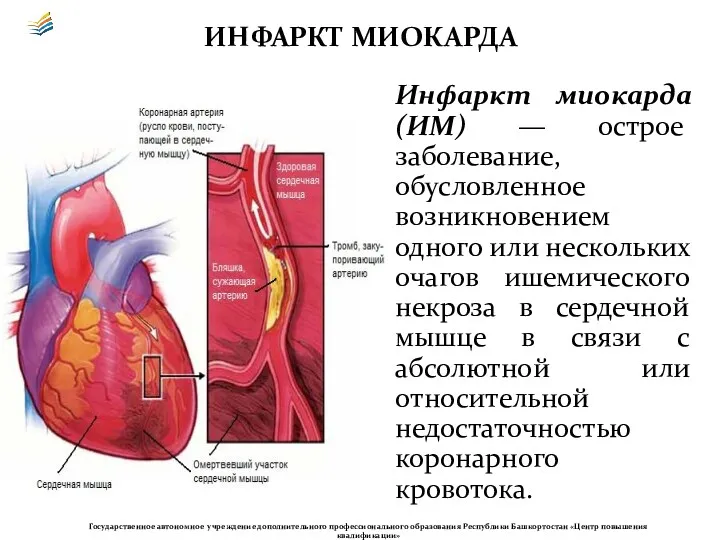 Инфаркт миокарда (ИМ) — острое заболевание, обусловленное возникновением одного или