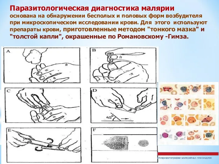 Паразитологическая диагностика малярии основана на обнаружении бесполых и половых форм