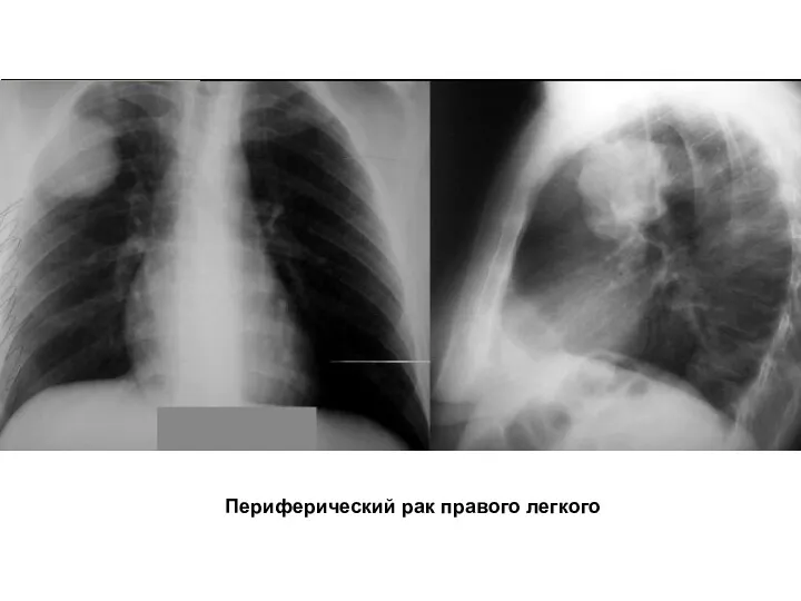 Периферический рак правого легкого