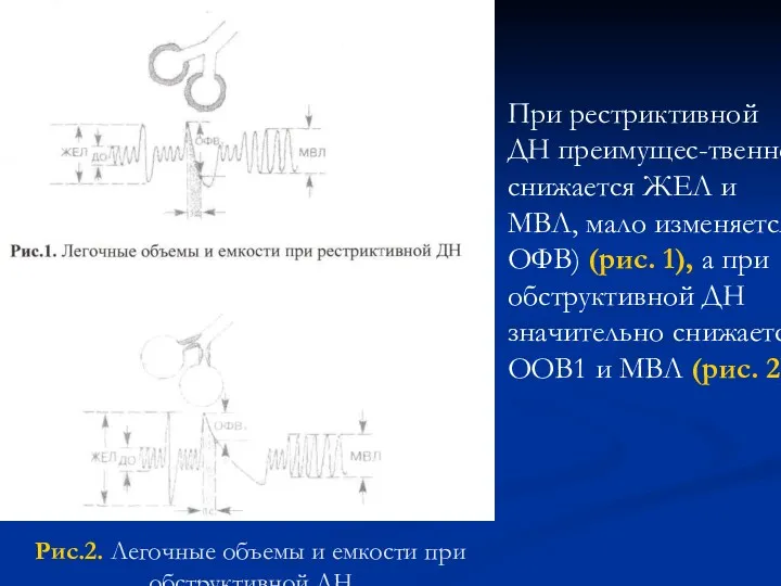 Рис.2. Легочные объемы и емкости при обструктивной ДН При рестриктивной