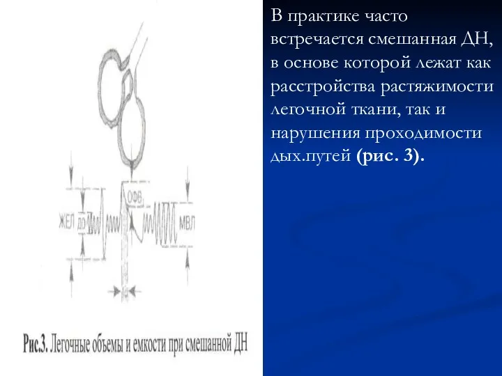 В практике часто встречается смешанная ДН, в основе которой лежат