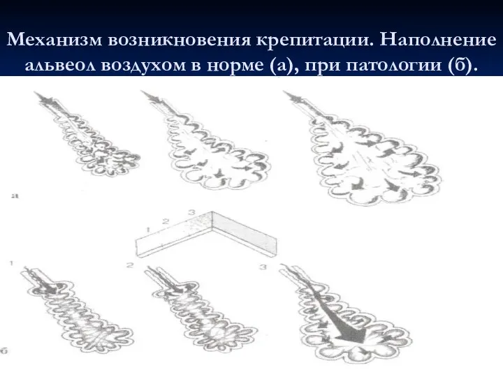 Механизм возникновения крепитации. Наполнение альвеол воздухом в норме (а), при патологии (б).