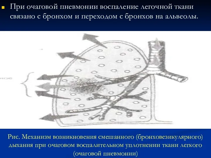 Рис. Механизм возникновения смешанного (бронховезикулярного) дыхания при очаговом воспалительном уплотнении