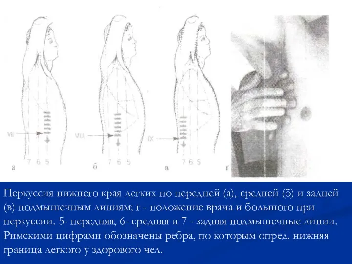 Перкуссия нижнего края легких по передней (а), средней (б) и