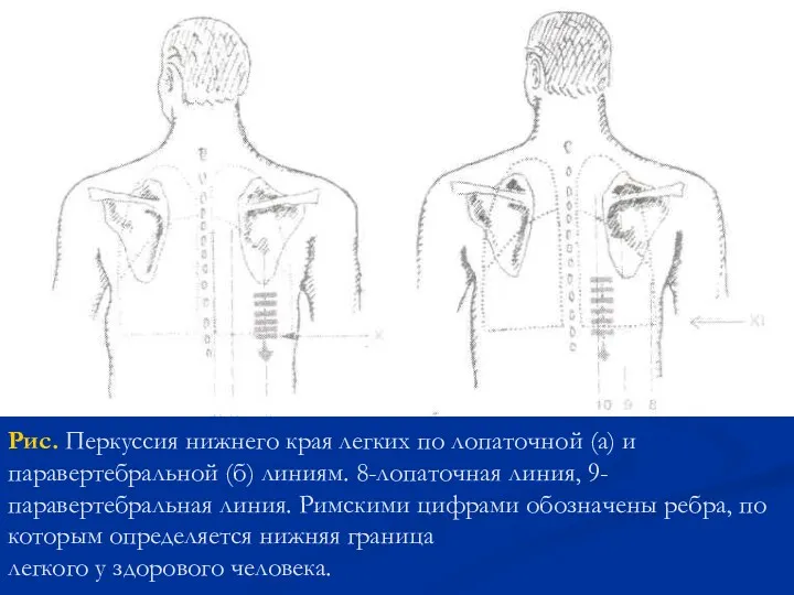 Рис. Перкуссия нижнего края легких по лопаточной (а) и паравертебральной