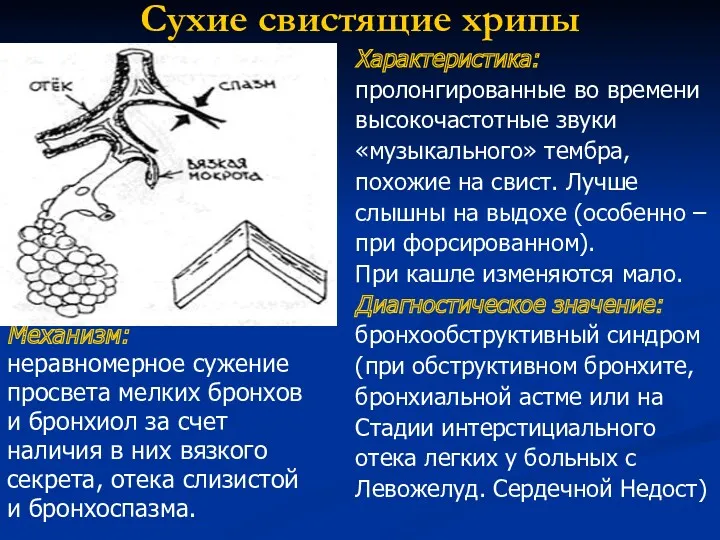 Сухие свистящие хрипы Механизм: неравномерное сужение просвета мелких бронхов и