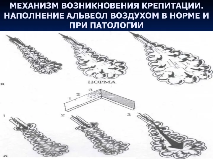 МЕХАНИЗМ ВОЗНИКНОВЕНИЯ КРЕПИТАЦИИ. НАПОЛНЕНИЕ АЛЬВЕОЛ ВОЗДУХОМ В НОРМЕ И ПРИ ПАТОЛОГИИ