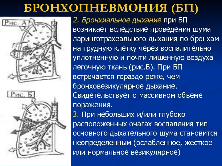 БРОНХОПНЕВМОНИЯ (БП) 2. Бронхиальное дыхание при БП возникает вследствие проведения