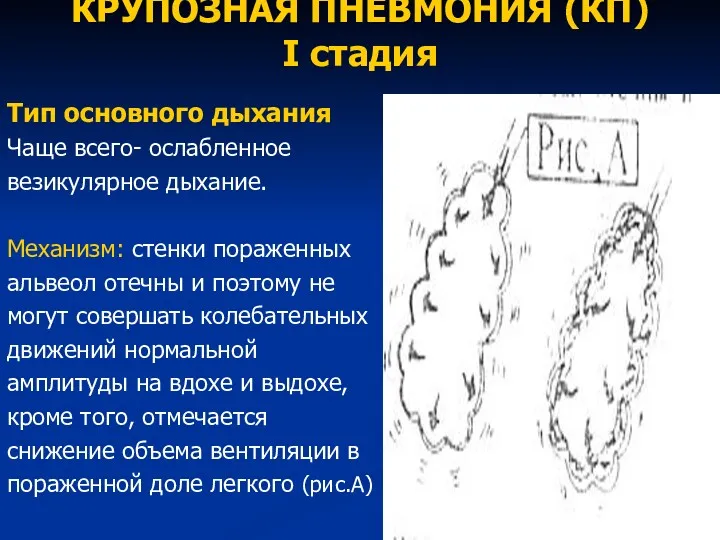 КРУПОЗНАЯ ПНЕВМОНИЯ (КП) I стадия Тип основного дыхания Чаще всего-