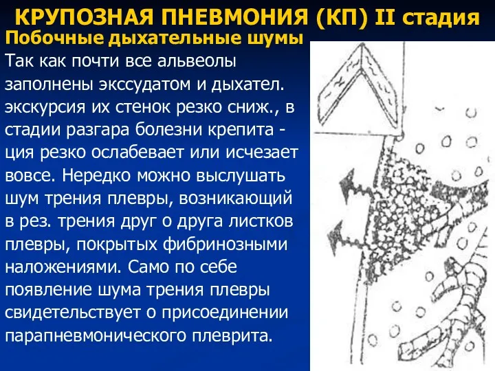 КРУПОЗНАЯ ПНЕВМОНИЯ (КП) II стадия Побочные дыхательные шумы Так как