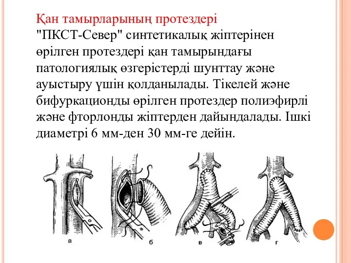 Қан тамырларының протездері "ПКСТ-Север" синтетикалық жіптерінен өрілген протездері қан тамырындағы