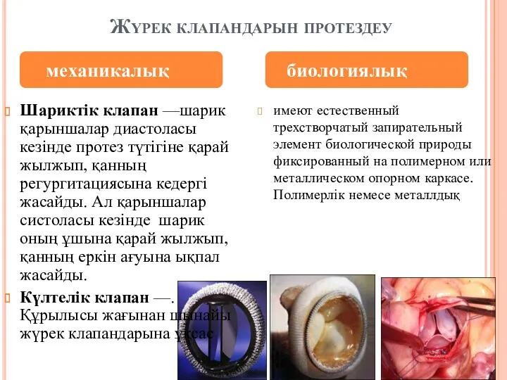 Жүрек клапандарын протездеу Шариктік клапан —шарик қарыншалар диастоласы кезінде протез