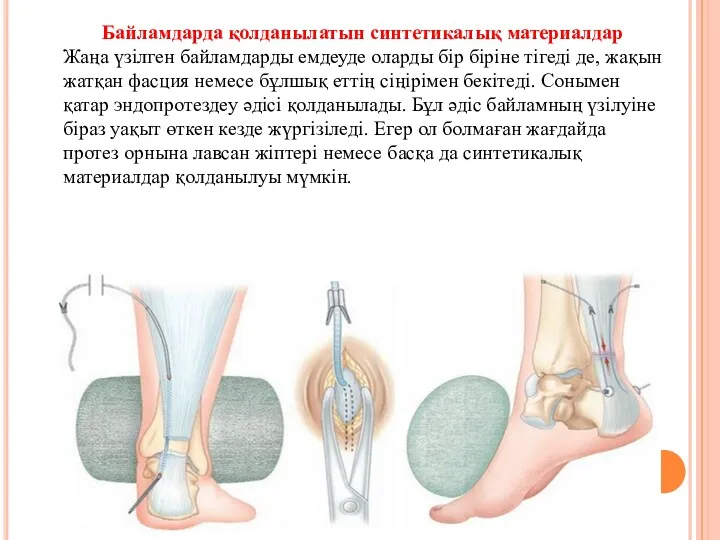 Байламдарда қолданылатын синтетикалық материалдар Жаңа үзілген байламдарды емдеуде оларды бір