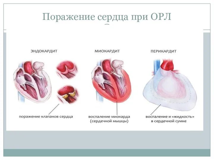 Поражение сердца при ОРЛ