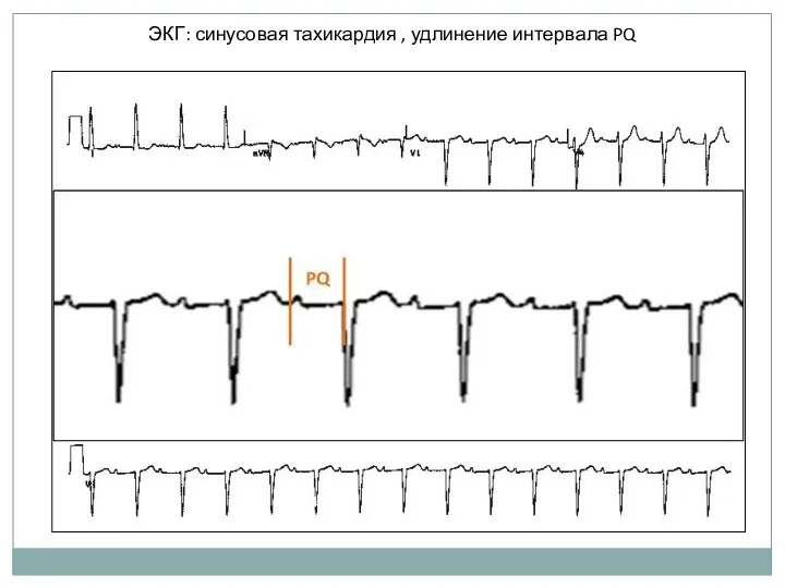 ЭКГ: синусовая тахикардия , удлинение интервала PQ