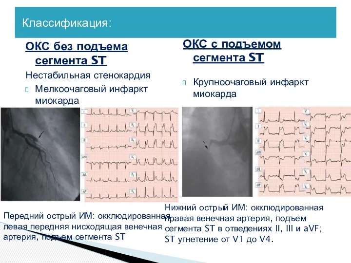 Классификация: ОКС без подъема сегмента ST Нестабильная стенокардия Мелкоочаговый инфаркт