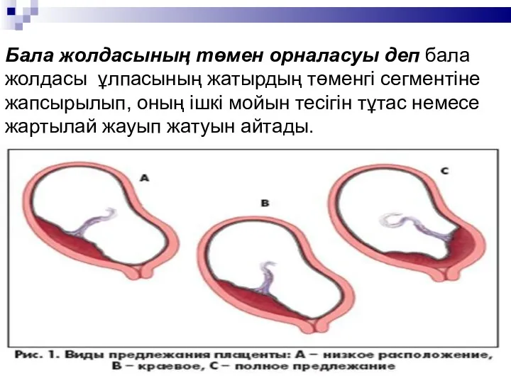 Бала жолдасының төмен орналасуы деп бала жолдасы ұлпасының жатырдың төменгі