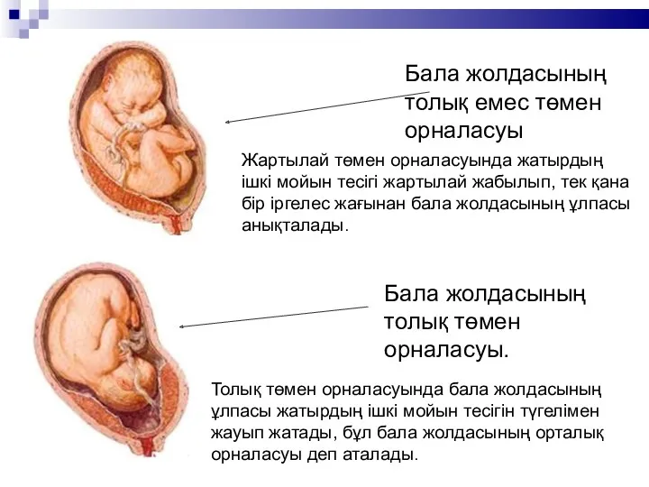 Бала жолдасының толық емес төмен орналасуы Бала жолдасының толық төмен орналасуы. Толық төмен