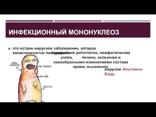 ИНФЕКЦИОННЫЙ МОНОНУКЛЕОЗ это острое вирусное заболевание, которое характеризуется лихорадкой, вирусом