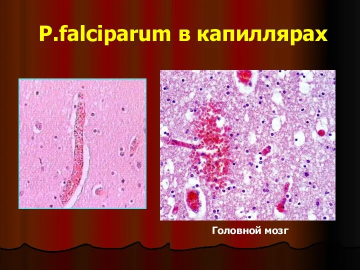 P.falciparum в капиллярах Головной мозг