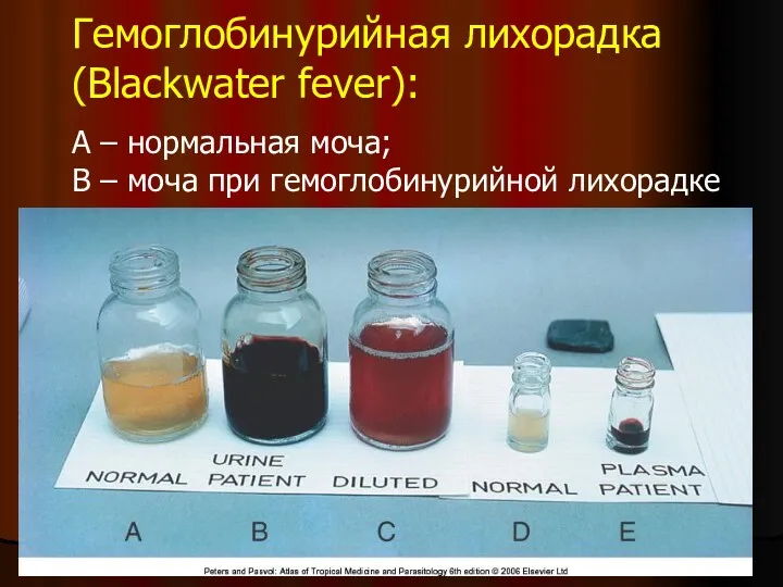 Гемоглобинурийная лихорадка (Blackwater fever): А – нормальная моча; В – моча при гемоглобинурийной лихорадке