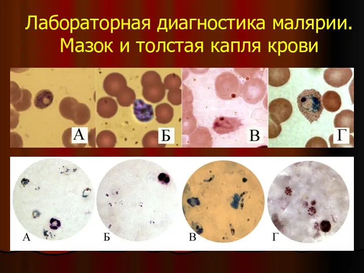 Лабораторная диагностика малярии. Мазок и толстая капля крови