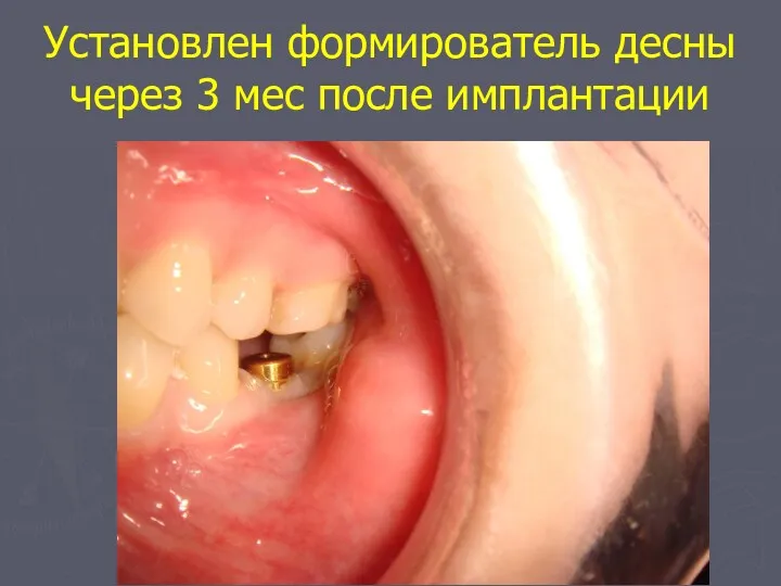 Установлен формирователь десны через 3 мес после имплантации