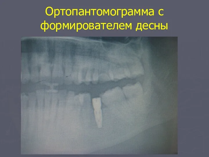 Ортопантомограмма с формирователем десны