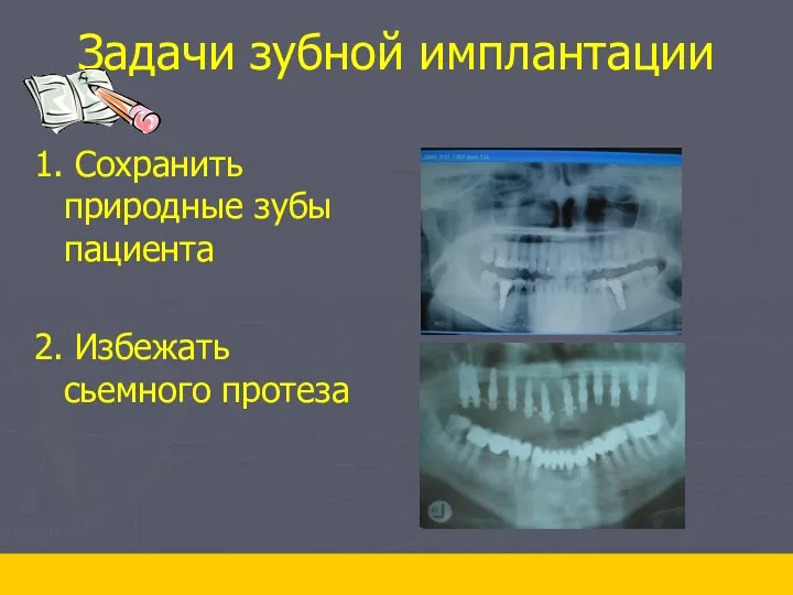 Задачи зубной имплантации 1. Сохранить природные зубы пациента 2. Избежать сьемного протеза