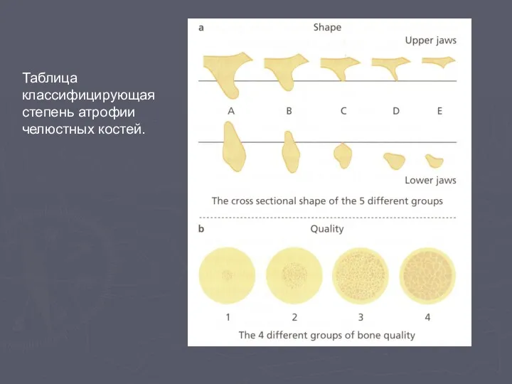 Таблица классифицирующая степень атрофии челюстных костей.