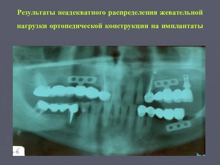 Результаты неадекватного распределения жевательной нагрузки ортопедической конструкции на имплантаты