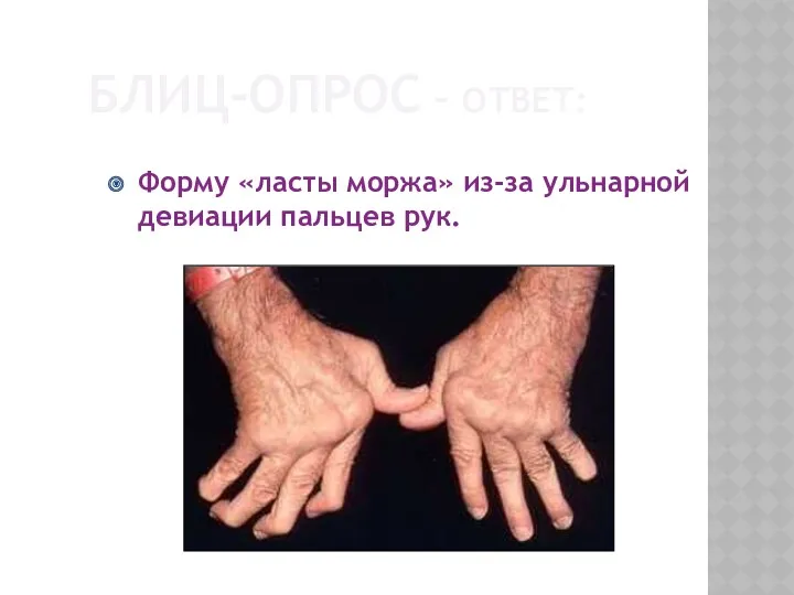 БЛИЦ-ОПРОС – ОТВЕТ: Форму «ласты моржа» из-за ульнарной девиации пальцев рук.