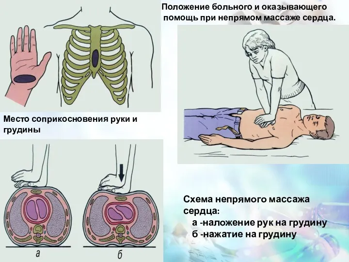 Место соприкосновения руки и грудины Положение больного и оказывающего помощь при непрямом массаже