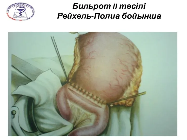 Бильрот II тәсілі Рейхель-Полиа бойынша