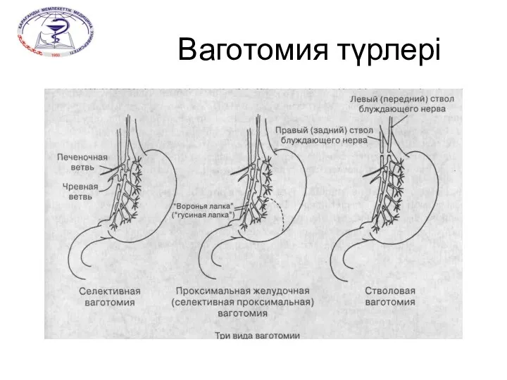 Ваготомия түрлері