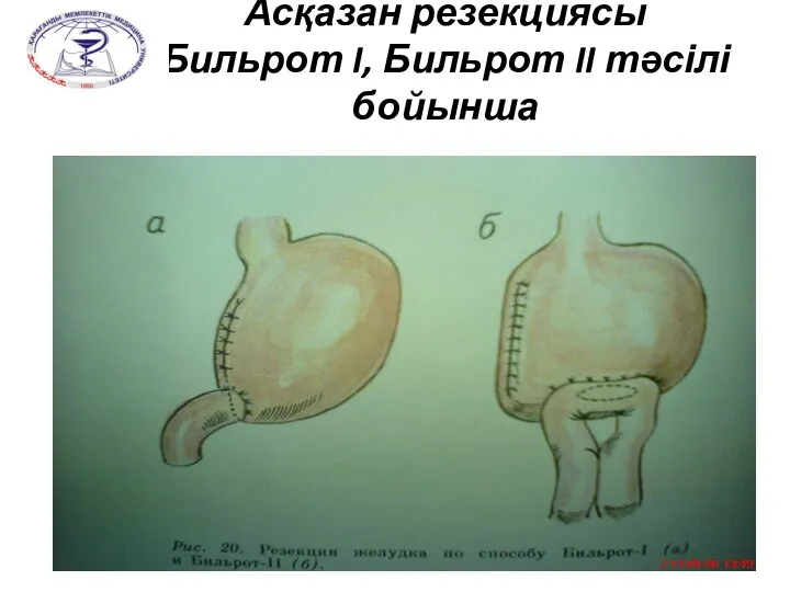 Асқазан резекциясы Бильрот I, Бильрот II тәсілі бойынша