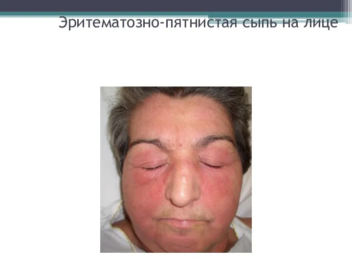 Эритематозно-пятнистая сыпь на лице